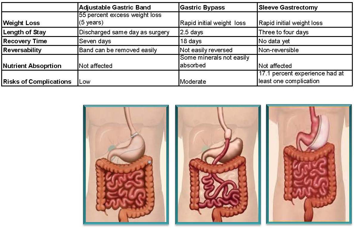 research paper on weight loss surgery