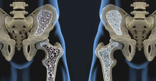 Know the subtle signs of osteoporosis