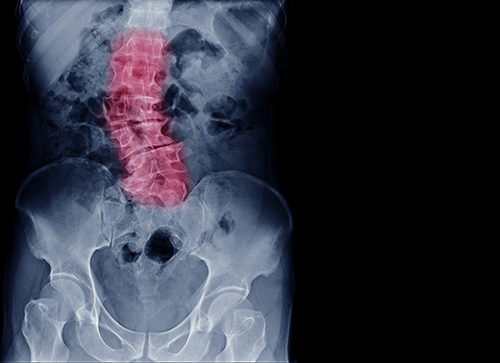 Scoliosis has many faces and just as many treatment options