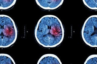 CT scans of a stroke sufferer's brain