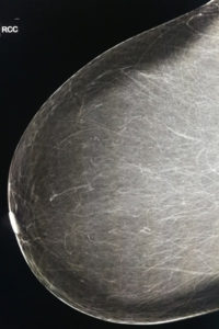 X-ray image of dense breast tissue