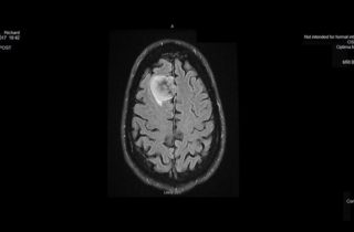 MRI image of Richard Giebelhausen's brain