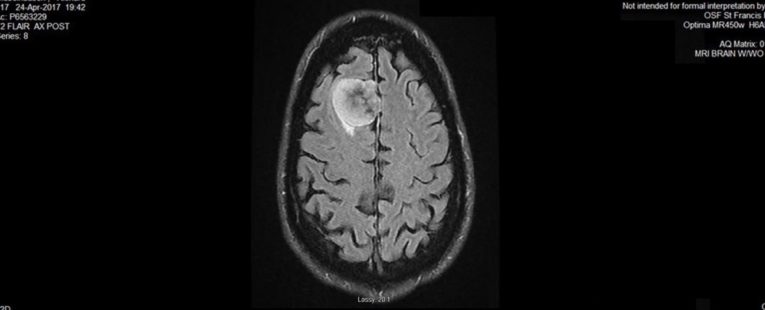MRI image of Richard Giebelhausen's brain