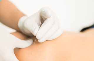 Physical therapy patient receiving dry needling therapy