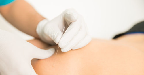 Dry needling provides a solution for pain and stiffness