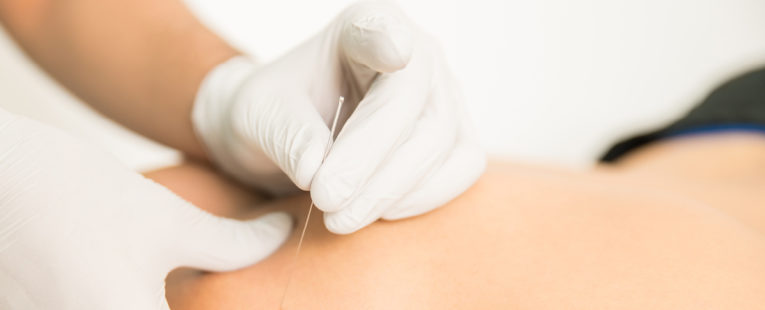 Physical therapy patient receiving dry needling therapy