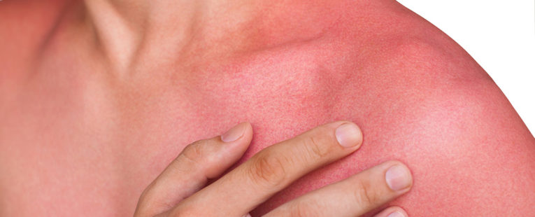 Heat rash, sun rash -- what's the | OSF HealthCare