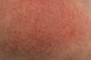 Sun rash from sun exposure on person's arm.