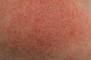 Heat Rash Sun Rash What S The Difference Osf Healthcare