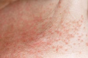 Prickly heat rash on a person's arm.
