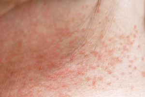 Heat Rash Sun Rash What S The Difference Osf Healthcare