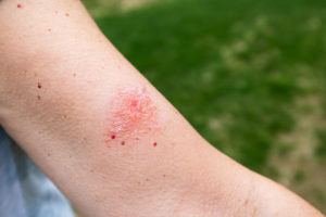 Poison ivy rash on person's arm.