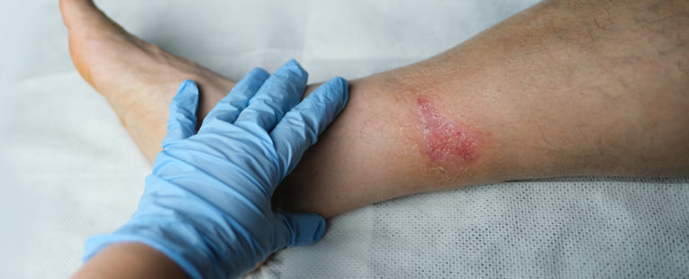 A doctor checking to see if a wound is healing or infected.