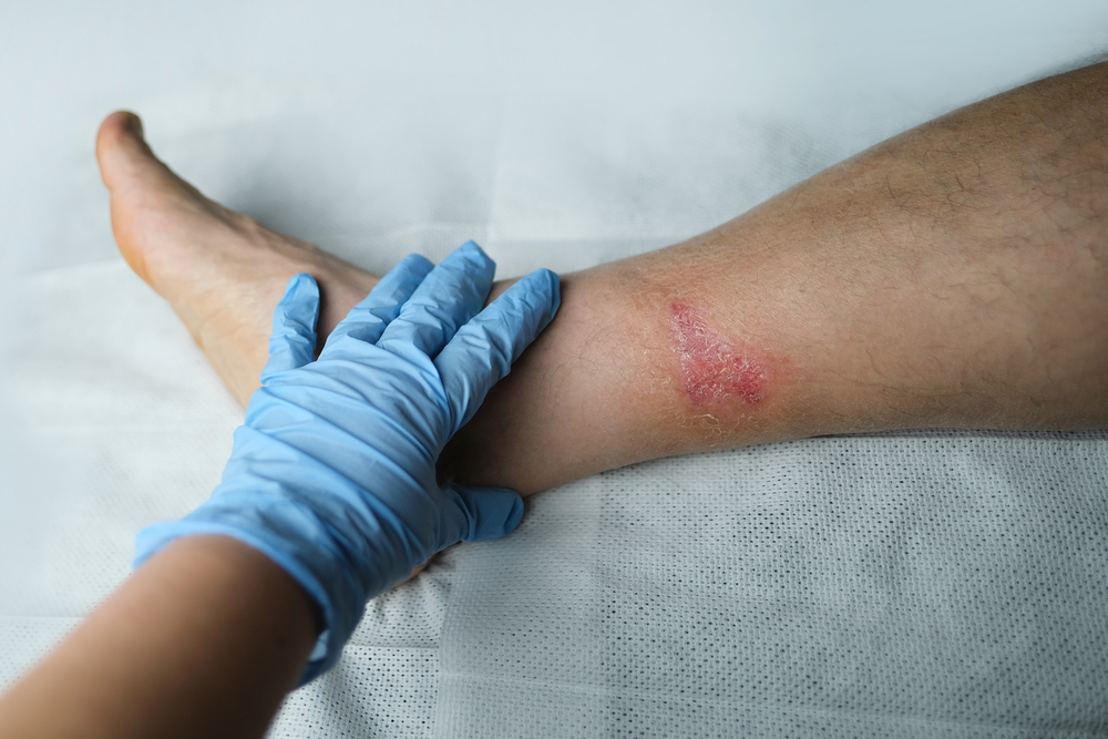 How To Tell If A Wound Is Healing Or Infected Osf Healthcare