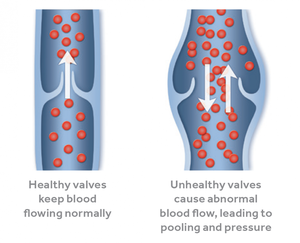 Backward blood flow from unhealthy leg valves