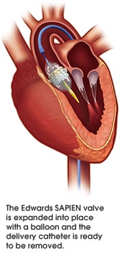 TAVR-placement-in-heart.jpg