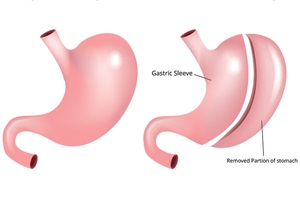 Gastric sleeve diagram
