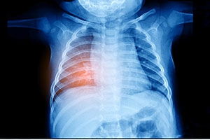 chest x-ray image