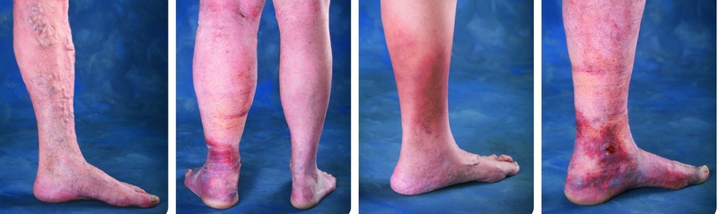 Varicose veins, swelling, and sores caused by venous reflux disease