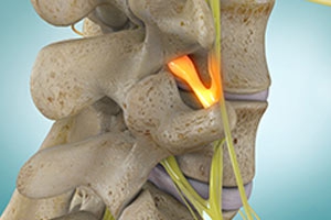 vid-Spinal-Stenosis.jpg